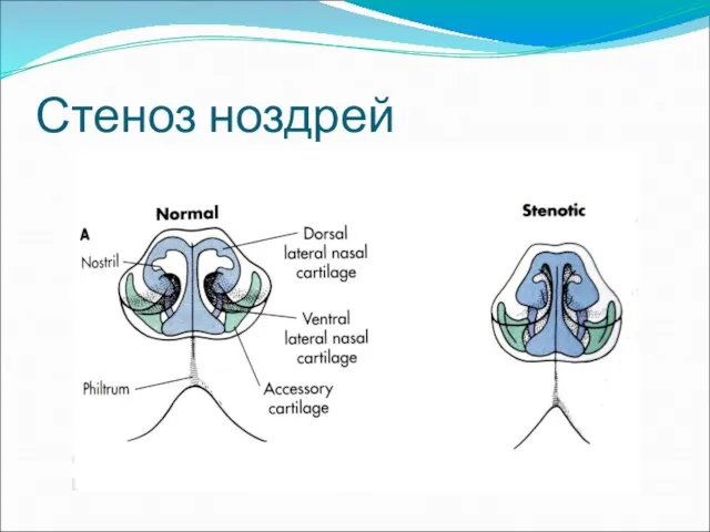 Стеноз ноздрей