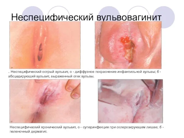 Неспецифический вульвовагинит . Неспецифический острый вульвит, о - диффузное покраснение инфантильной вульвы;