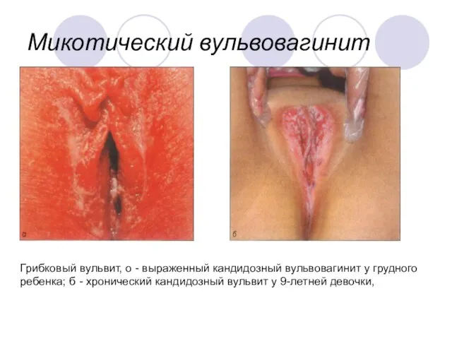 Микотический вульвовагинит Грибковый вульвит, о - выраженный кандидозный вульвовагинит у грудного ребенка;