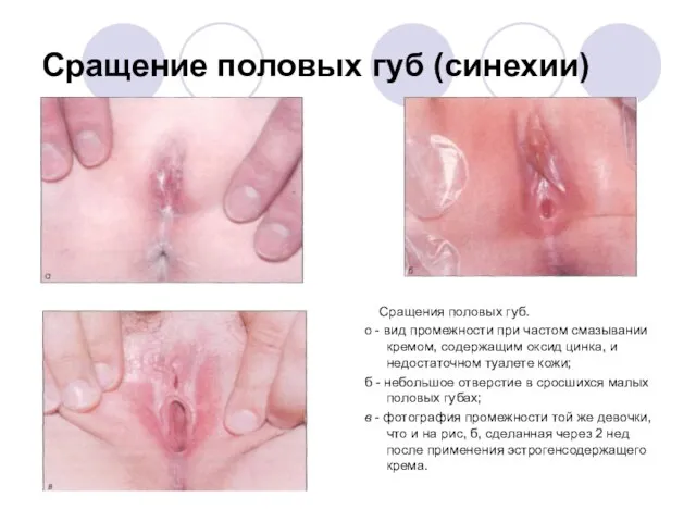 Сращение половых губ (синехии) Сращения половых губ. о - вид промежности при