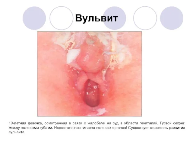 Вульвит 10-летняя девочка, осмотренная в связи с жалобами на зуд в области