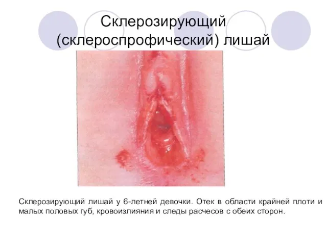 Склерозирующий (склероспрофический) лишай Склерозирующий лишай у 6-летней девочки. Отек в области крайней