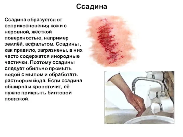 Ссадина Ссадина образуется от соприкосновения кожи с неровной, жёсткой поверхностью, например землёй,