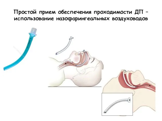 Простой прием обеспечения проходимости ДП – использование назофарингеальных воздуховодов