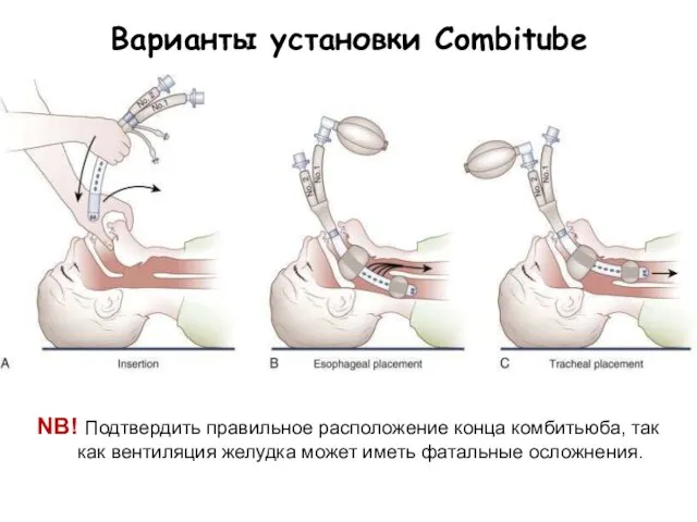 Варианты установки Combitube NB! Подтвердить правильное расположение конца комбитьюба, так как вентиляция