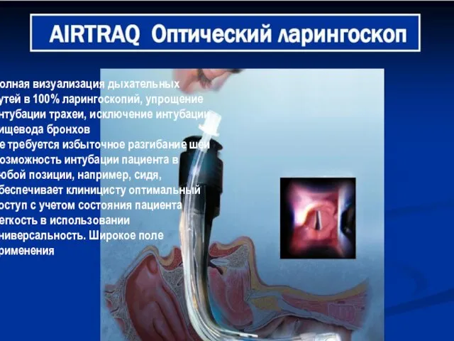 Полная визуализация дыхательных путей в 100% ларингоскопий, упрощение интубации трахеи, исключение интубации