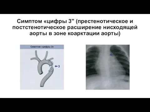 Симптом «цифры 3" (престенотическое и постстенотическое расширение нисходящей аорты в зоне коарктации аорты)