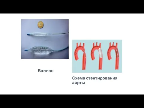 Баллон Схема стентирования аорты