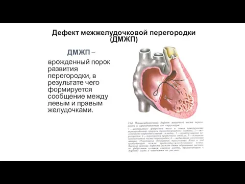 Дефект межжелудочковой перегородки (ДМЖП) ДМЖП – врожденный порок развития перегородки, в результате