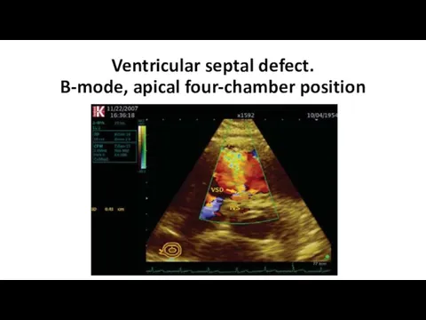 Ventricular septal defect. B-mode, apical four-chamber position