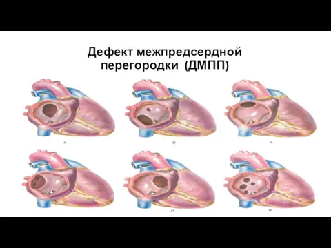 Дефект межпредсердной перегородки (ДМПП)