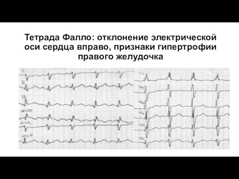 Тетрада Фалло: отклонение электрической оси сердца вправо, признаки гипертрофии правого желудочка