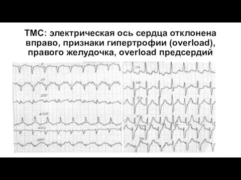 TMС: электрическая ось сердца отклонена вправо, признаки гипертрофии (overload), правого желудочка, overload предсердий