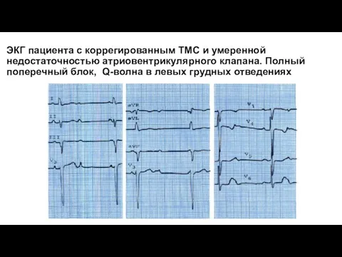 ЭКГ пациента с коррегированным TMС и умеренной недостаточностью атриовентрикулярного клапана. Полный поперечный