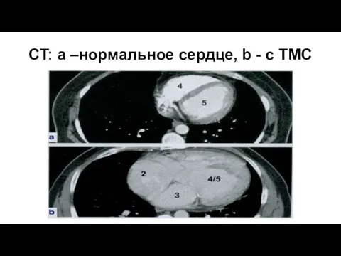 CT: a –нормальное сердце, b - с TMС
