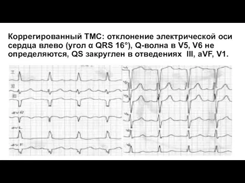 Коррегированный TMС: отклонение электрической оси сердца влево (угол α QRS 16°), Q-волна