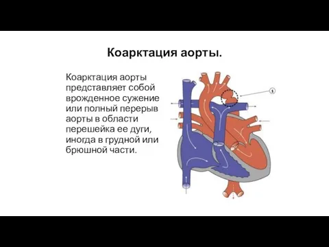 Коарктация аорты. Коарктация аорты представляет собой врожденное сужение или полный перерыв аорты