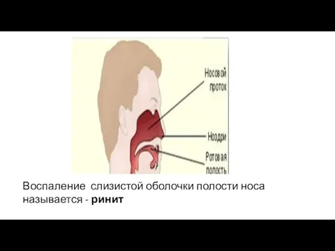 Воспаление слизистой оболочки полости носа называется - ринит