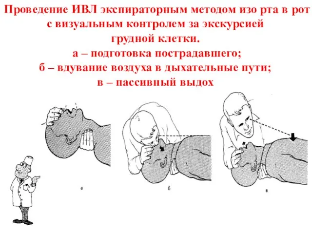 Проведение ИВЛ экспираторным методом изо рта в рот с визуальным контролем за