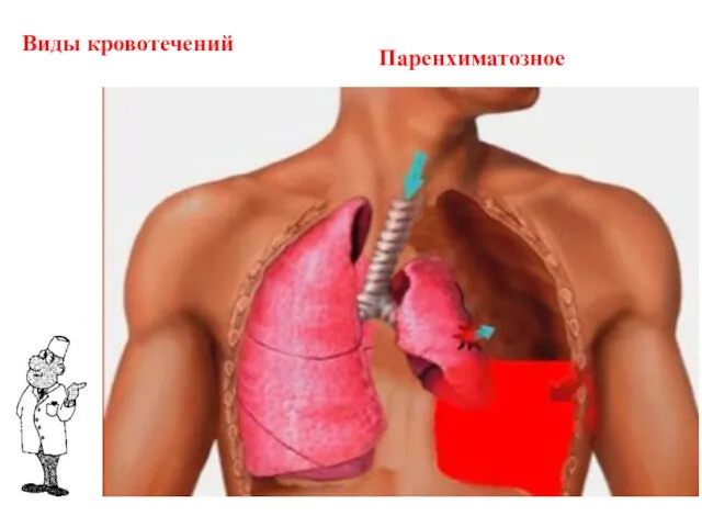 Виды кровотечений Паренхиматозное