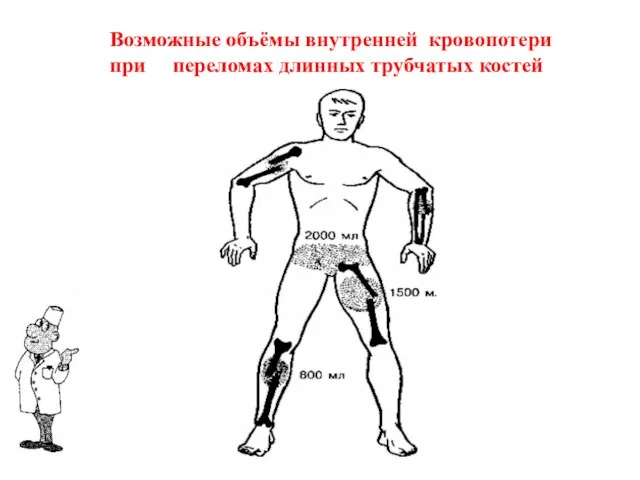 Возможные объёмы внутренней кровопотери при переломах длинных трубчатых костей