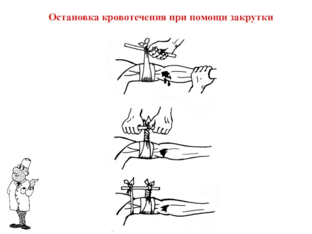 Остановка кровотечения при помощи закрутки