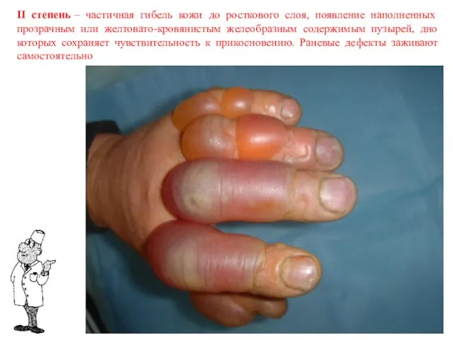 II степень – частичная гибель кожи до росткового слоя, появление наполненных прозрачным