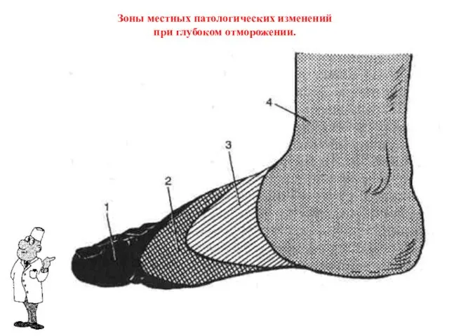 Зоны местных патологических изменений при глубоком отморожении.