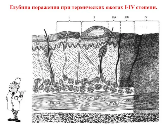 Глубина поражения при термических ожогах I-IV степени.