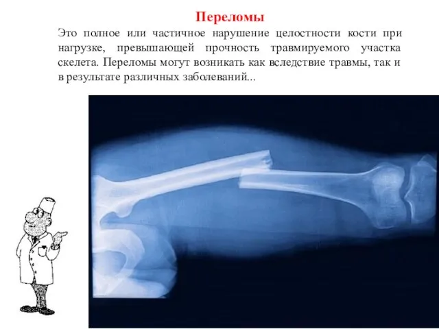 Переломы Это полное или частичное нарушение целостности кости при нагрузке, превышающей прочность