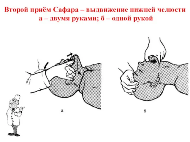 Второй приём Сафара – выдвижение нижней челюсти а – двумя руками; б – одной рукой