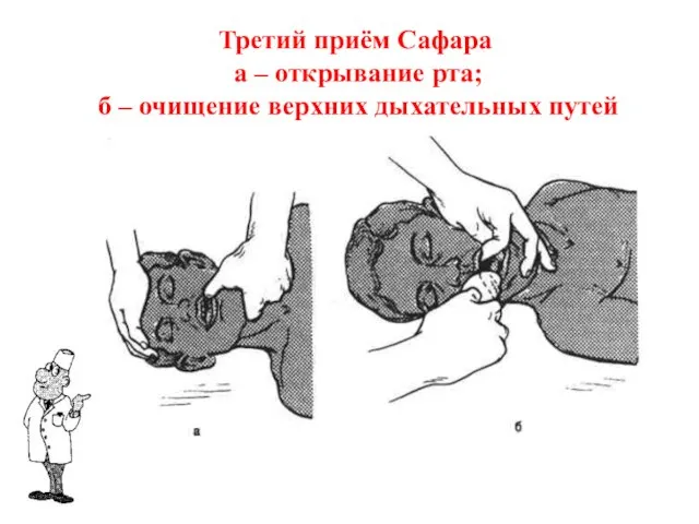 Третий приём Сафара а – открывание рта; б – очищение верхних дыхательных путей