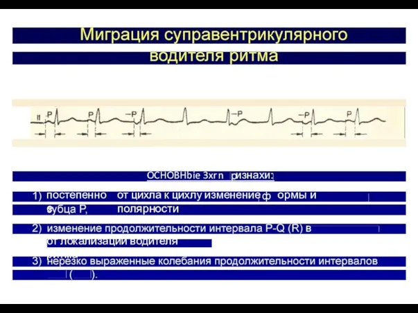 постепенное от локализации водителя ритма R-R P-P OCHOBHbie 3xr n изнахи: от