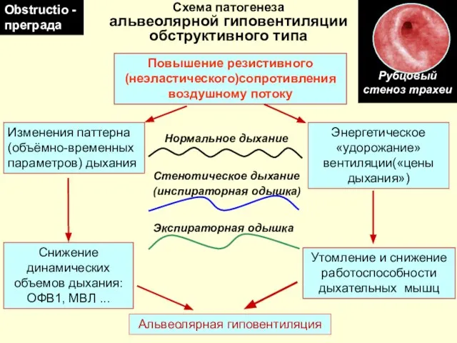 Рубцовый стеноз трахеи Схема патогенеза альвеолярной гиповентиляции обструктивного типа Повышение резистивного (неэластического)сопротивления