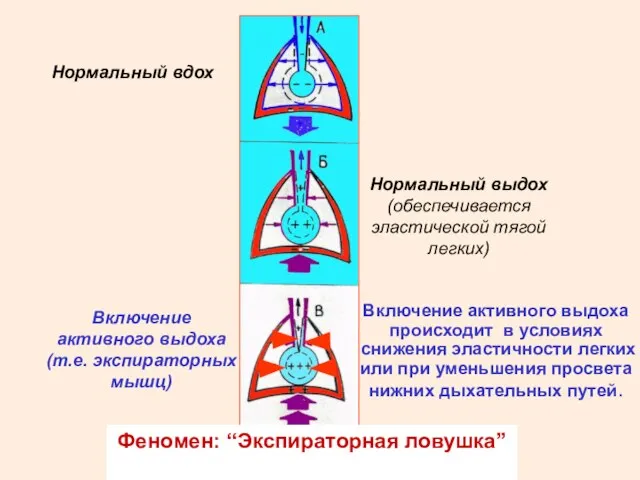 Феномен: “Экспираторная ловушка” Нормальный вдох Нормальный выдох (обеспечивается эластической тягой легких) Включение