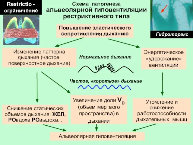 Схема патогенеза альвеолярной гиповентиляции рестриктивного типа Повышение эластического сопротивления дыханию Изменение паттерна