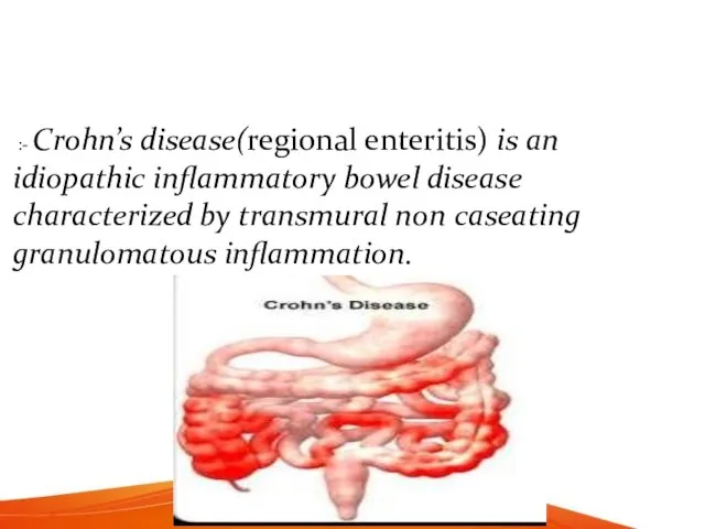 :- Crohn’s disease(regional enteritis) is an idiopathic inflammatory bowel disease characterized by