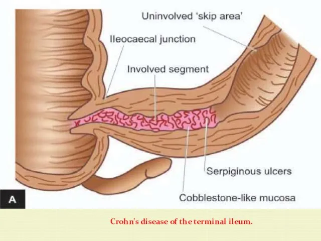 Crohn’s disease of the terminal ileum.