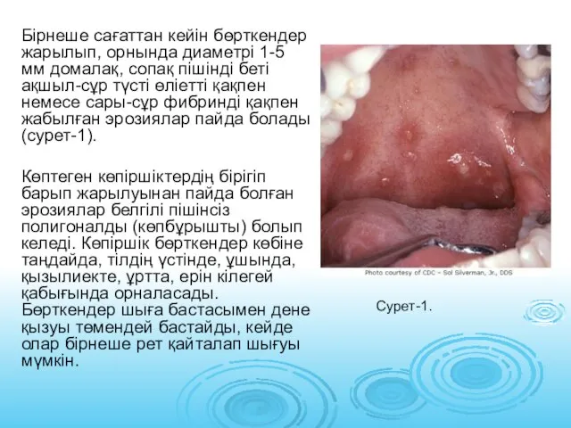 Бірнеше сағаттан кейін бөрткендер жарылып, орнында диаметрі 1-5 мм домалақ, сопақ пішінді