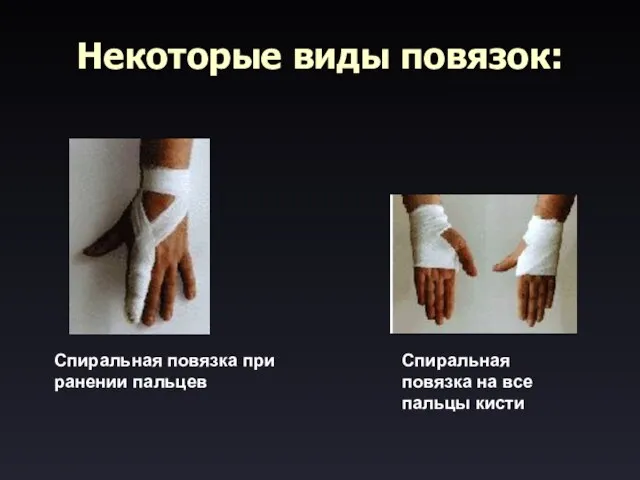 Некоторые виды повязок: Спиральная повязка при ранении пальцев Спиральная повязка на все пальцы кисти
