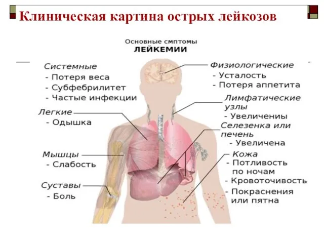 Клиническая картина острых лейкозов