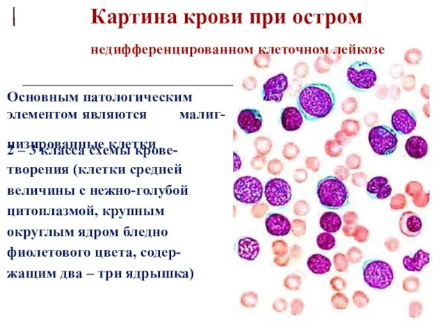 Картина крови при остром недифференцированном клеточном лейкозе Основным патологическим элементом являются низированные