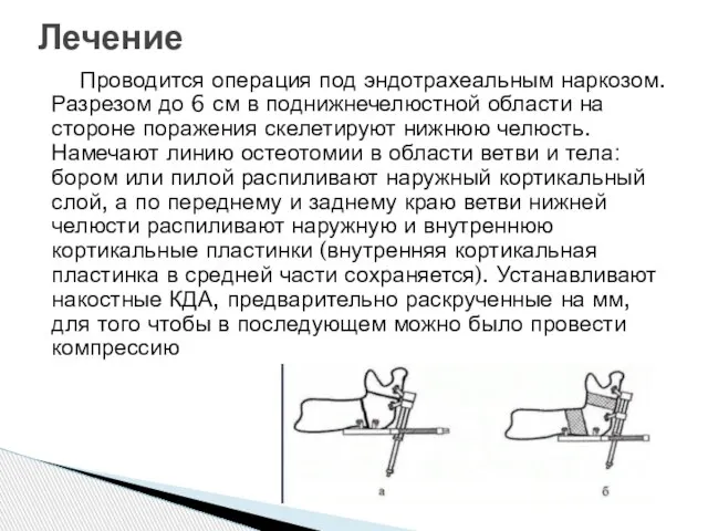 Проводится операция под эндотрахеальным наркозом. Разрезом до 6 см в поднижнечелюстной области