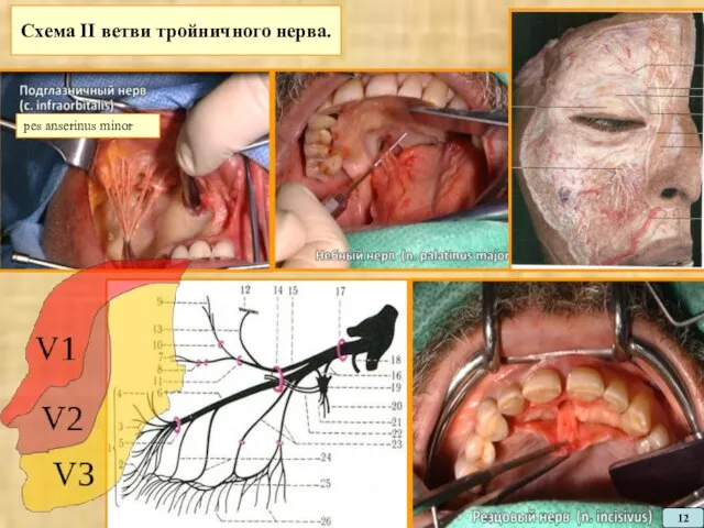Схема II ветви тройничного нерва. pes anserinus minor 12