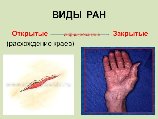 ВИДЫ РАН Открытые инфицированные Закрытые (расхождение краев)