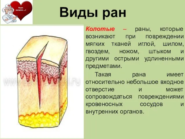 Колотые – раны, которые возникают при повреждении мягких тканей иглой, шилом, гвоздем,