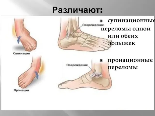 Различают: супинационные переломы одной или обеих лодыжек пронационные переломы