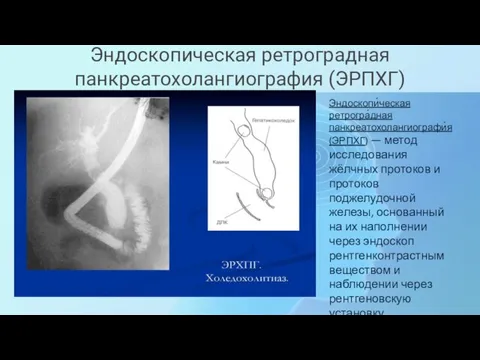 Эндоскопическая ретроградная панкреатохолангиография (ЭРПХГ) Эндоскопи́ческая ретрогра́дная панкреатохолангиографи́я (ЭРПХГ) — метод исследования жёлчных