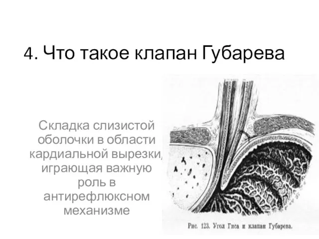 4. Что такое клапан Губарева Складка слизистой оболочки в области кардиальной вырезки,