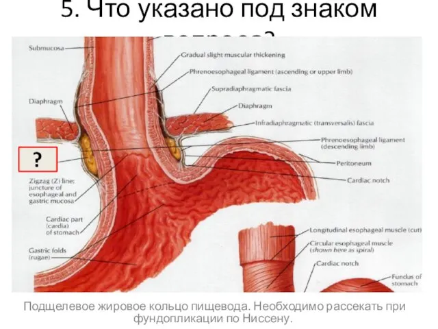 5. Что указано под знаком вопроса? А ? Подщелевое жировое кольцо пищевода.